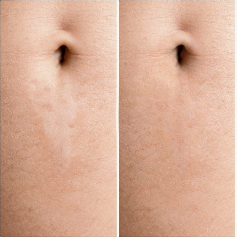 Dehnungsstreifen Schwangerschaftsstreifen