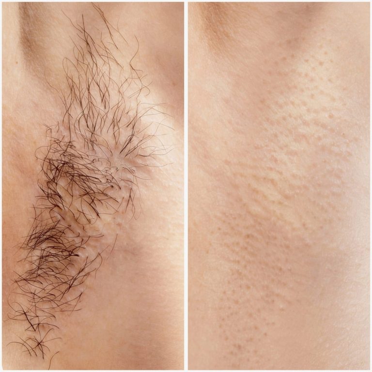 BB Glow Meso Therapie