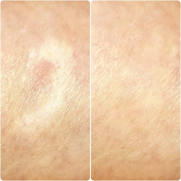 Permanent Camouflage - Narben Pigmentierung