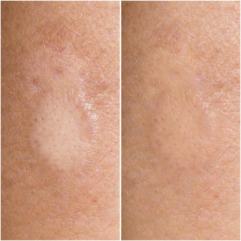 Dehnungsstreifen Schwangerschaftsstreifen