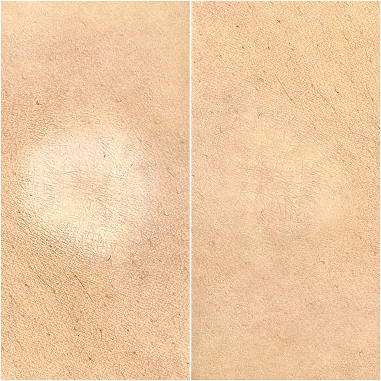 Permanent Camouflage - Narben Pigmentierung